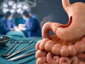 gastro entero anastomose